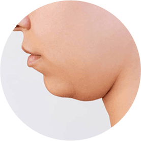 Double Chin
