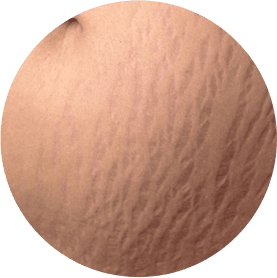 Stretch Mark